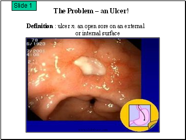The Problem – an Ulcer!