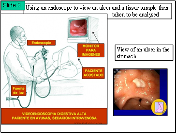 Using an endoscope to view an ulcer and a tissue sample then