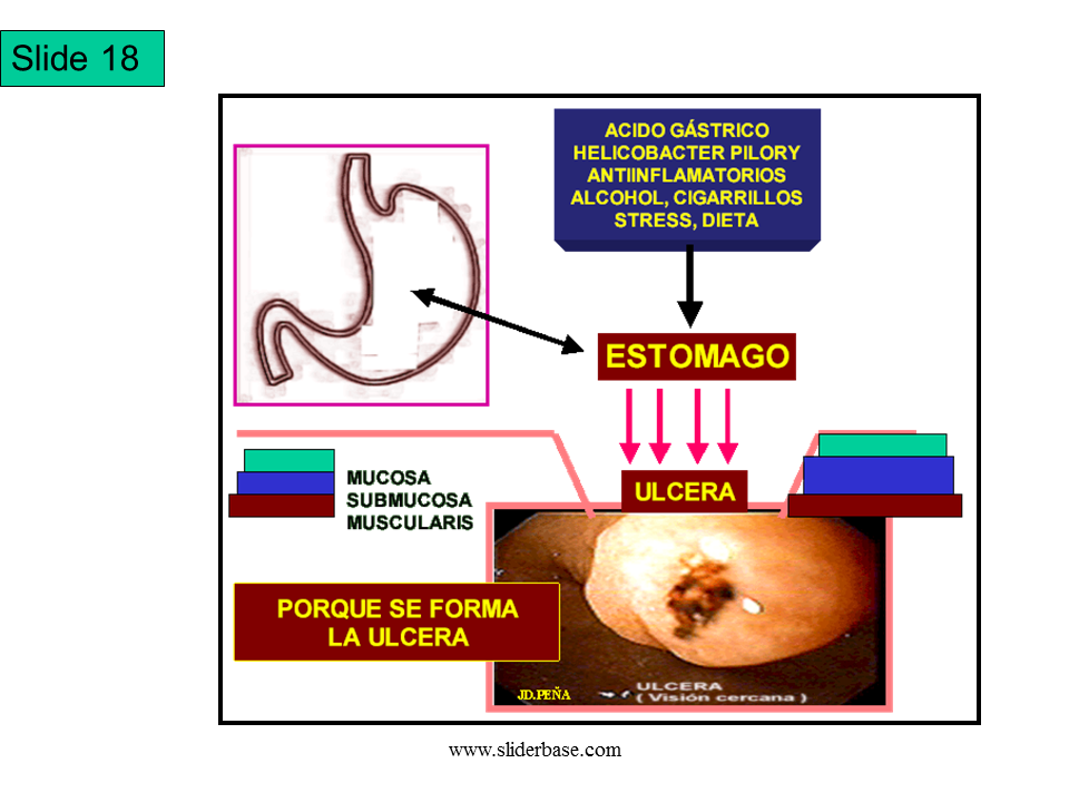 Bacteria del estomago helicobacter pylori tratamiento