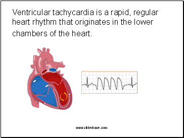 Ventricular tachycardia is a rapid, regular heart rhyth that originates in the lower chambers of the heart.