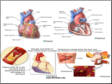 Coronary heart disease