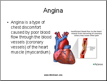 Angina