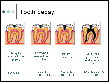 Tooth decay