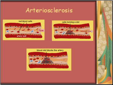 Arteriosclerosis