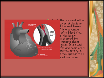 Heart disease most often occurs when cholesterol accumulates and forms "plaque" in a coronary artery. With blood flow impeded, the heart becomes starved for oxygen, causing chest pain (angina). If a blood clot forms and completely obstructs the artery, a heart attack (myocardial infarction) can occur.