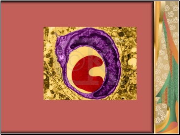 Heart disease arteriosclerosis