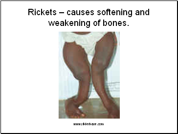 Rickets – causes softening and weakening of bones.