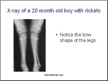 X-ray of a 20 month old boy with rickets
