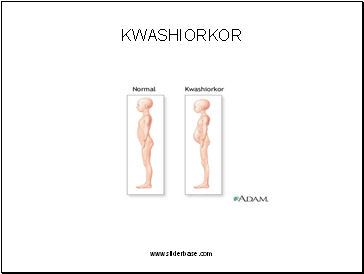 KWASHIORKOR