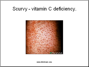 Scurvy - vitamin C deficiency.