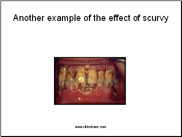 Another example of the effect of scurvy