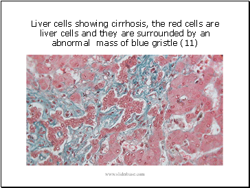Liver cells showing cirrhosis, the red cells are liver cells and they are surrounded by an abnormal mass of blue gristle (11)
