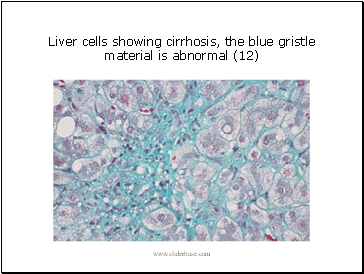 Liver cells showing cirrhosis, the blue gristle material is abnormal (12)