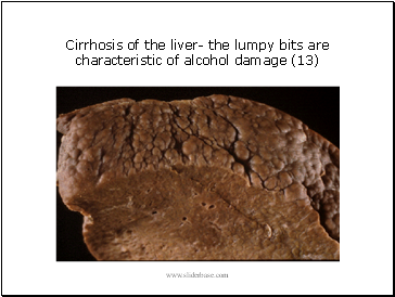 Cirrhosis of the liver