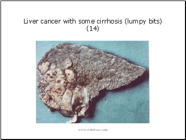 Liver cancer with some cirrhosis (lumpy bits) (14)