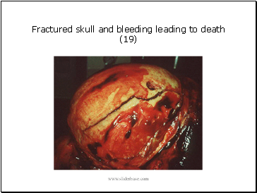 Fractured skull and bleeding leading to death (19)