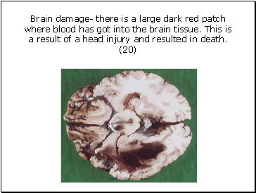 Brain damage