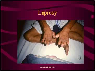 Leprosy