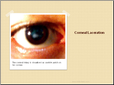 Corneal Laceration