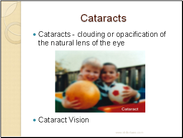 Cataracts