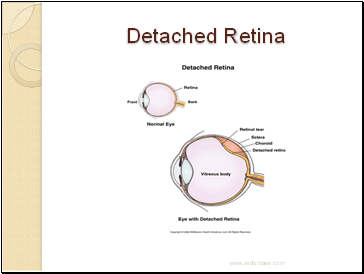 Detached Retina