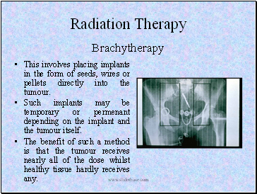 Radiation Therapy Brachytherapy