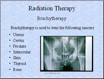 Radiation Therapy Brachytherapy