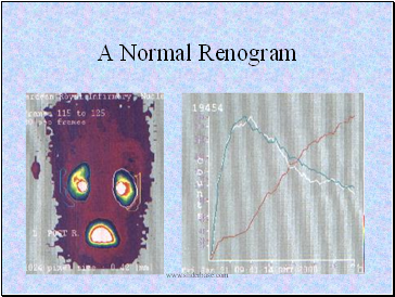 A Normal Renogram