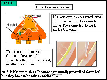 How the ulcer is formed